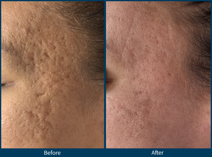Microneedling Austin TX