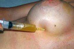 breaast seroma