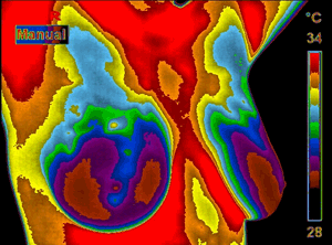 breast thermogram