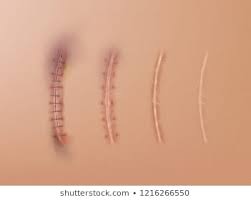 scars 1