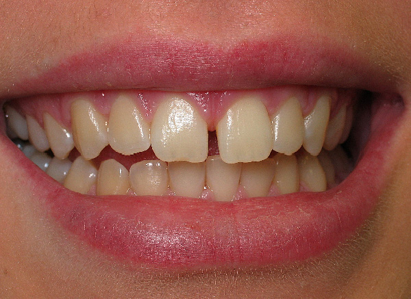 Front tooth gap
