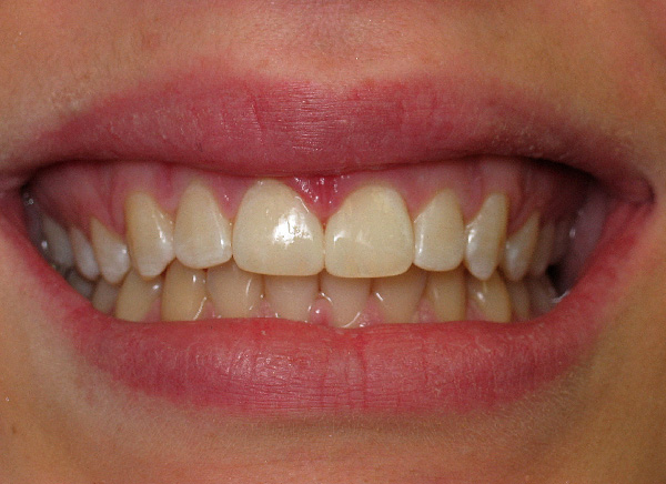 Tooth gap closure