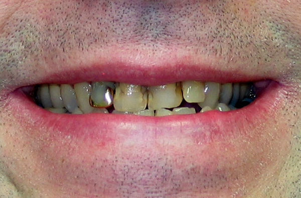 Dark front teeth with old fillings