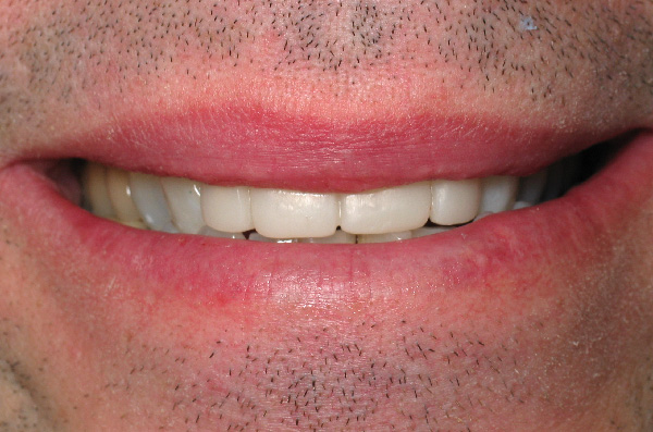 White front teeth with restored fillings