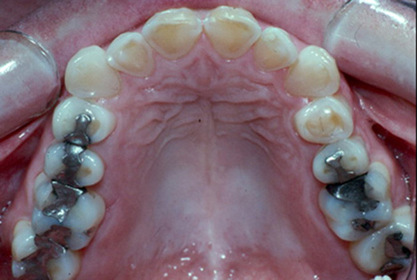 Old fillings on upper teeth