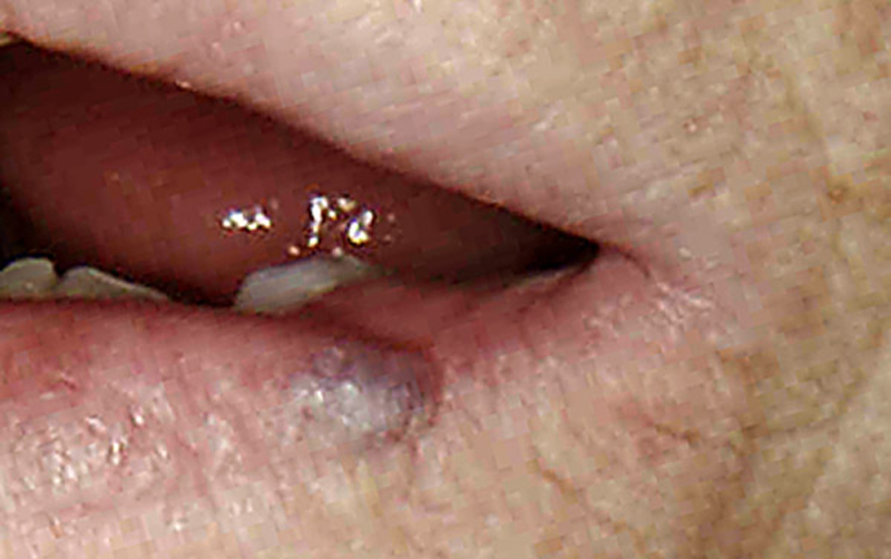 Hematoma on a patient's lip