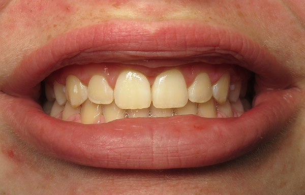 Successfule gingival contouring