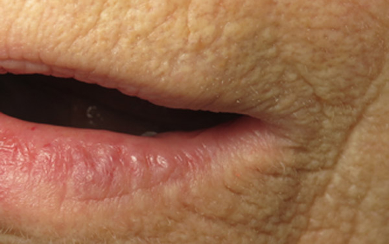 Fixed lip hematoma