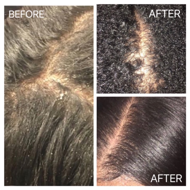 5 Benefits that Glycolic Acid Plays in Hair Growth and Scalp Health