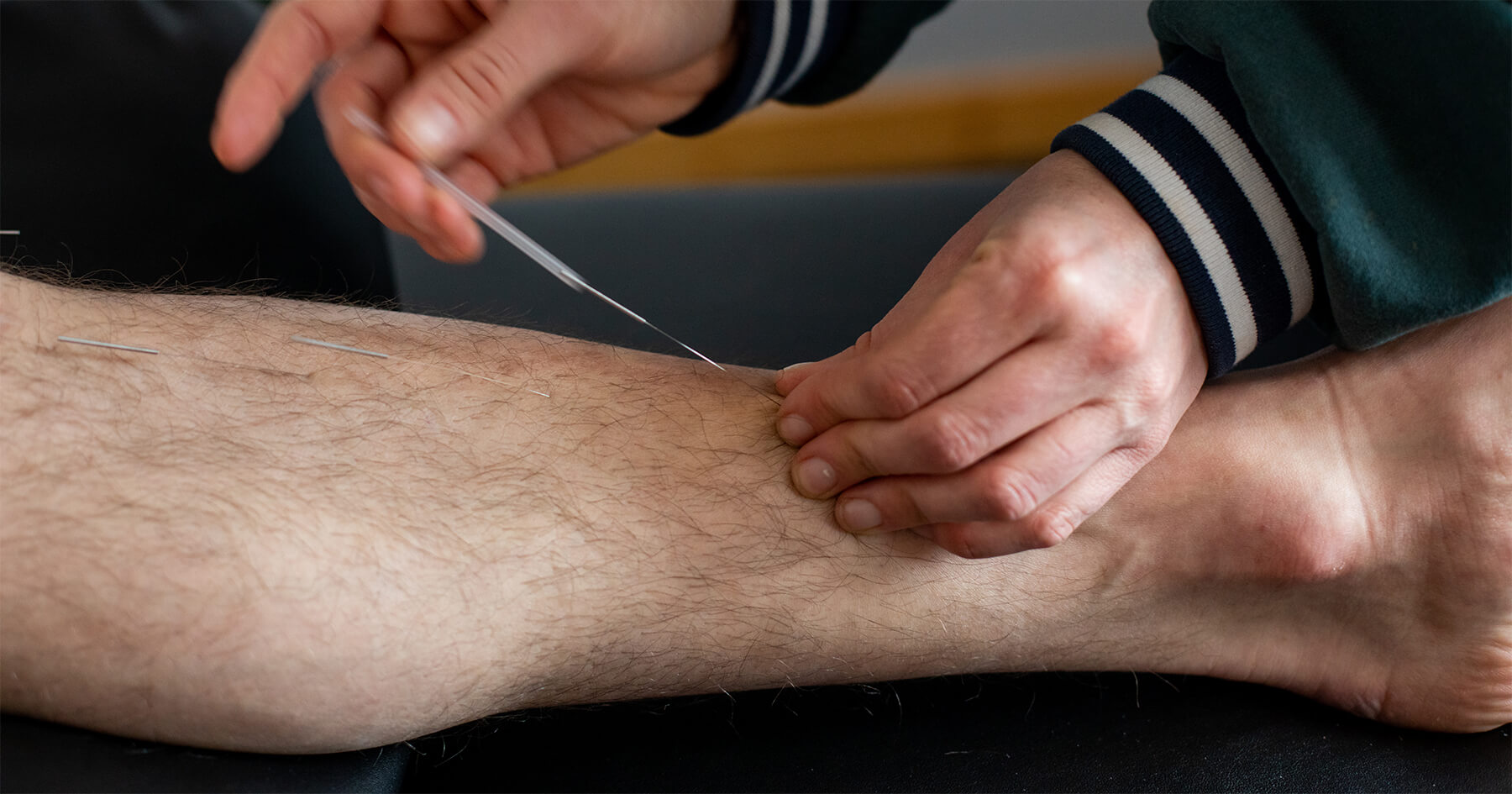 acupuncture-leg