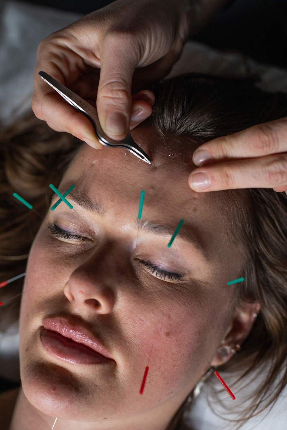 woman-facial-acupuncture at medicine wheel wellness in jackson, wy