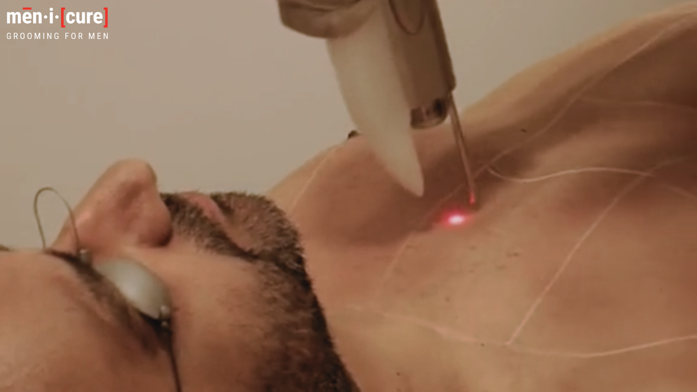 The Ultimate Guide Benefits of Laser Hair Removal for Men