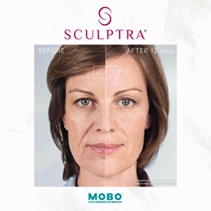 Sculptra Aesthetic: Unlocking Age-Defying Results