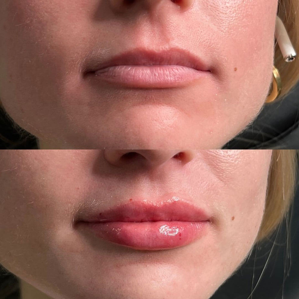 Lip-Filler-Juvederm-MOBO-Med-Spa