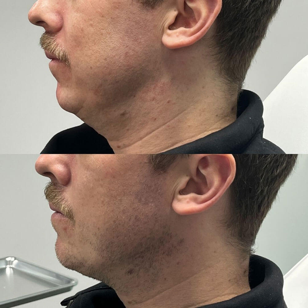 Jawline-Filler-MOBO-Med-Spa