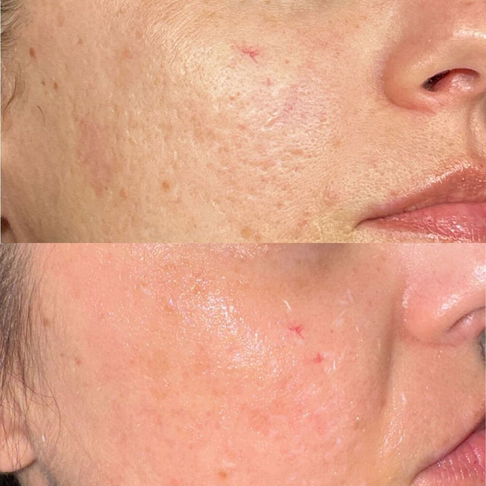 Laser-radiofrequency-Acne-Scarring-MOBO-Med-Spa