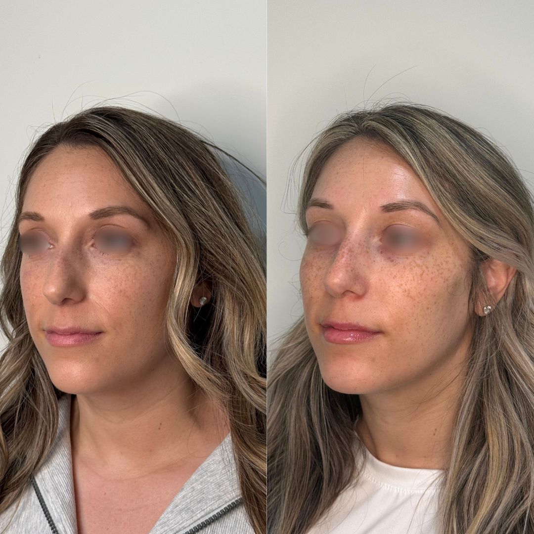 facial-balancing-filler-mobo-med-spa