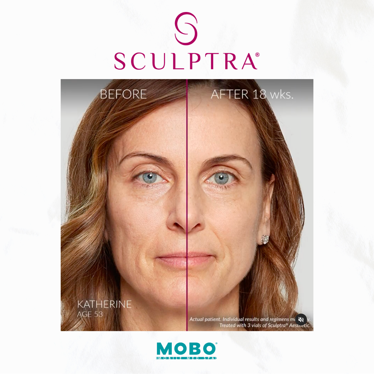 Sculptra Before and After