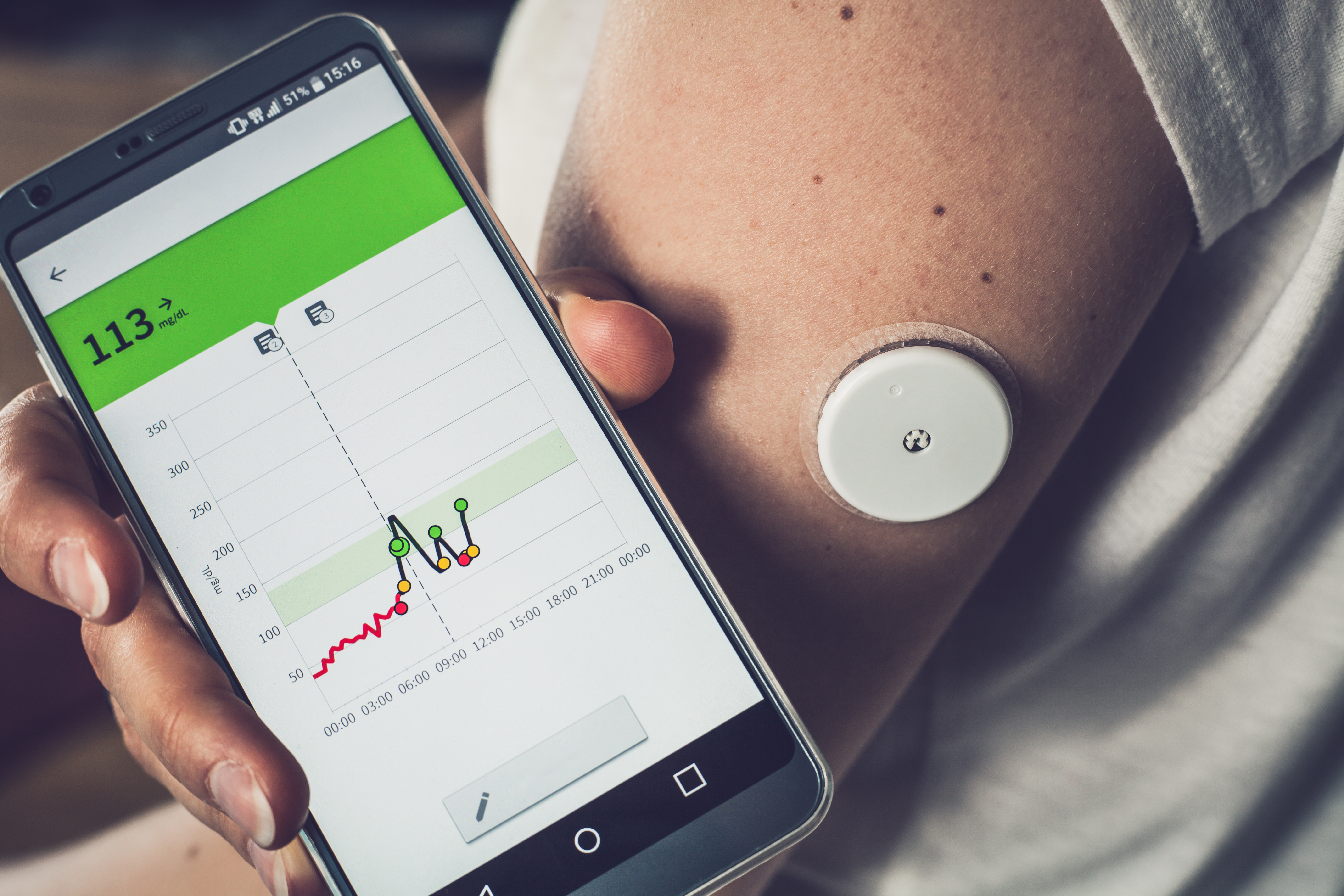 Continuous Glucose Monitor for Weight Loss