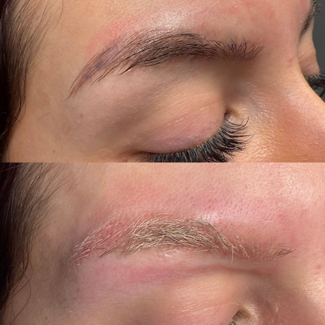 Laser Eyebrow Tattoo Removal