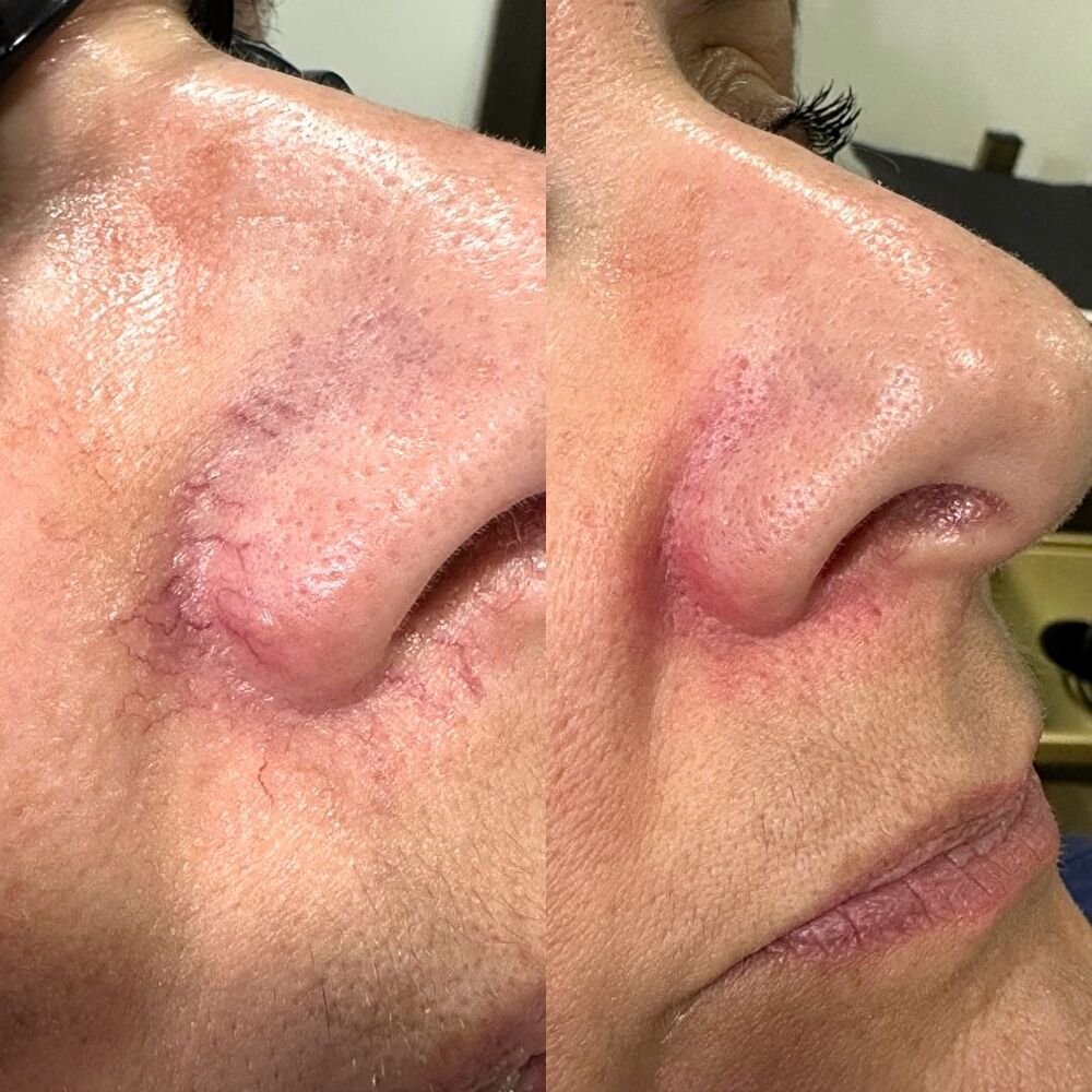 Nose-Veins-Laser-Treatment-MOBO-Med-Spa