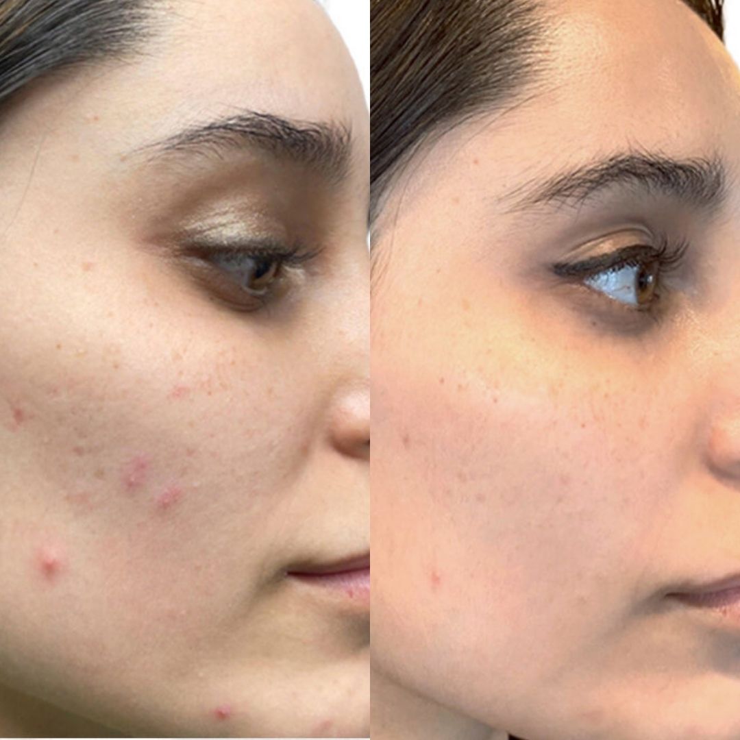 VI-PEEL-MOBO-Med-Spa-acne
