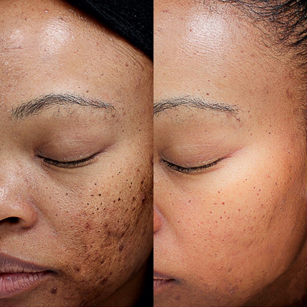 VI-PEEL-MOBO-Med-Spa-darker-skin-type