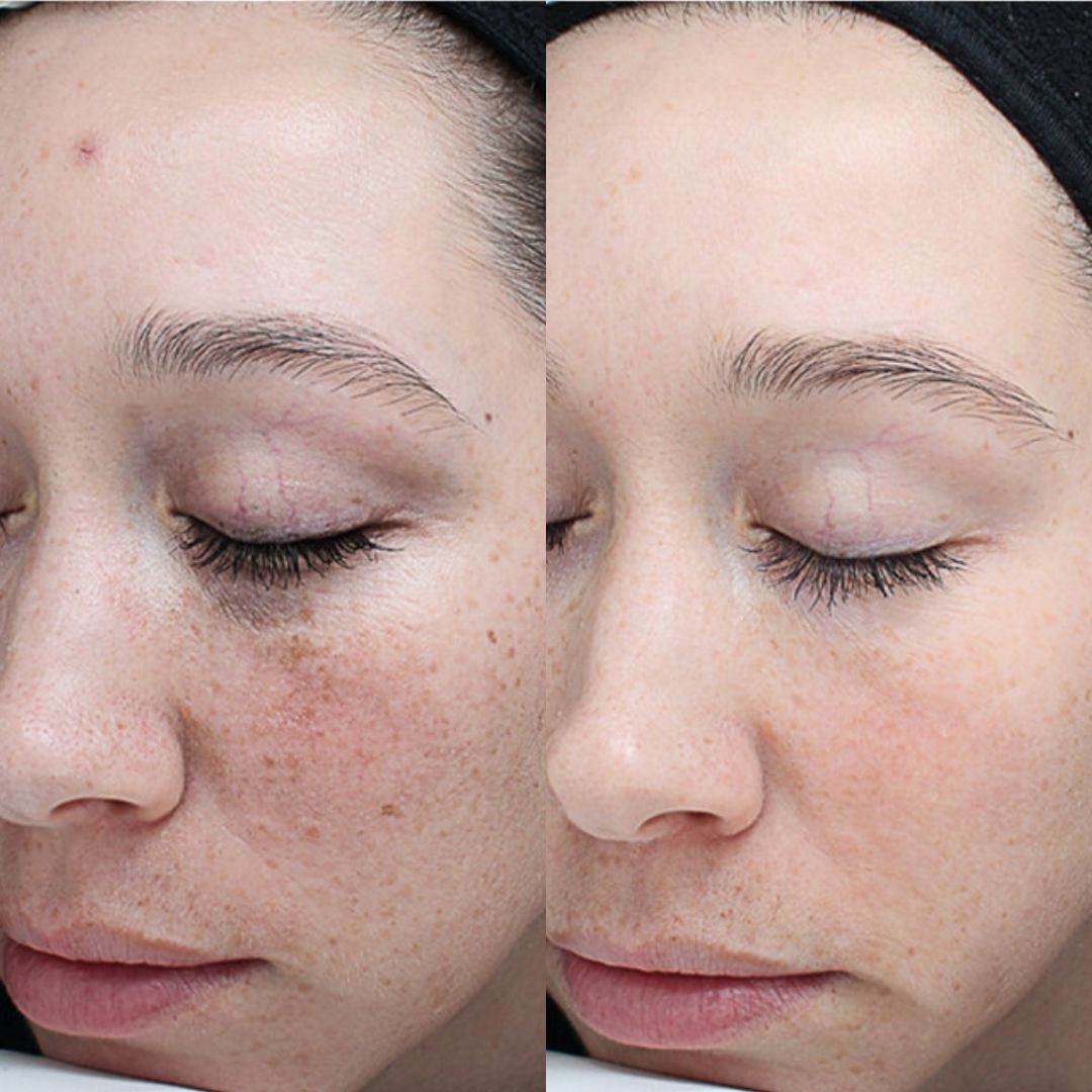 VI-PEEL-PIGMENT-MOBO-Med-Spa