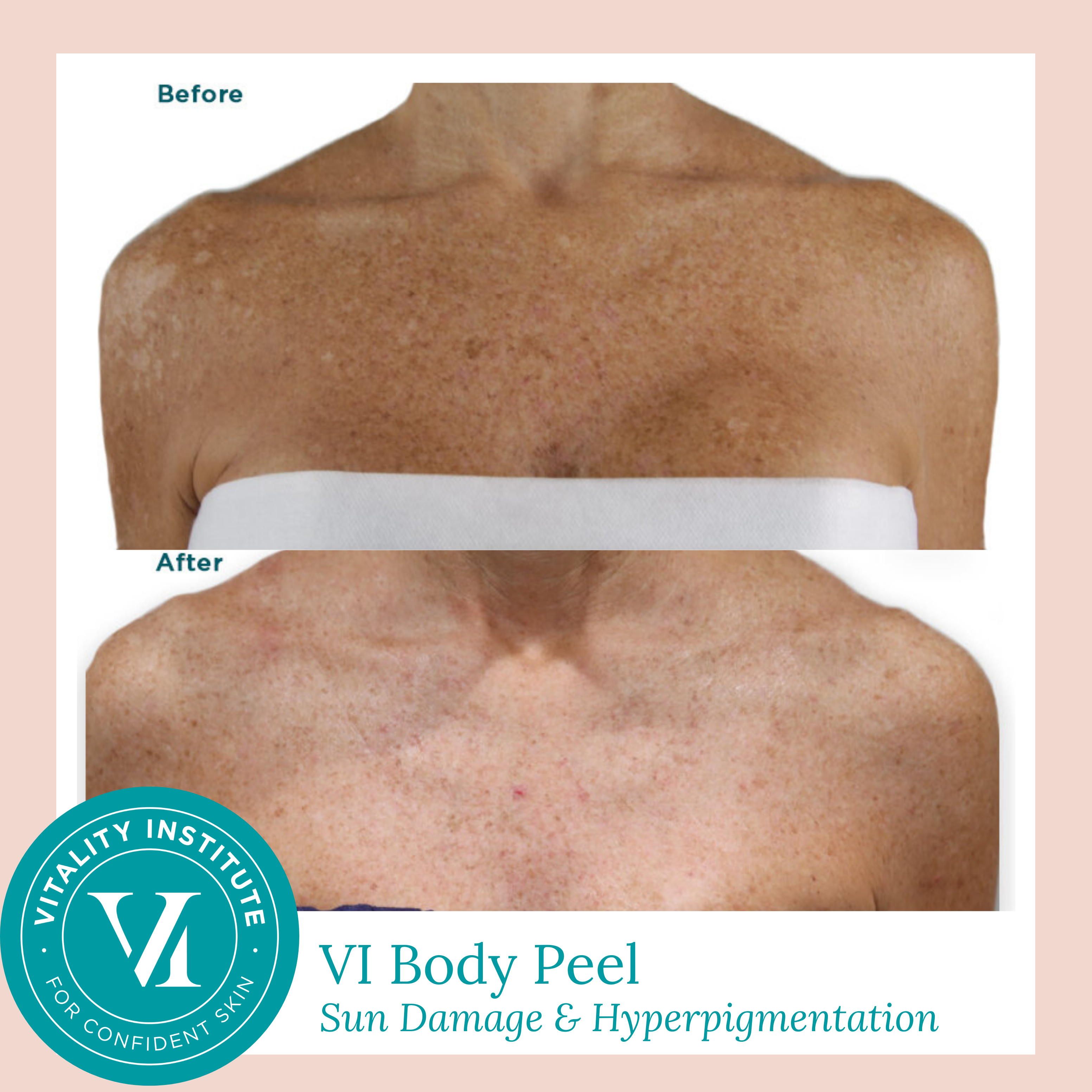VI_Peel_for_Chest_Before_and_After (1)