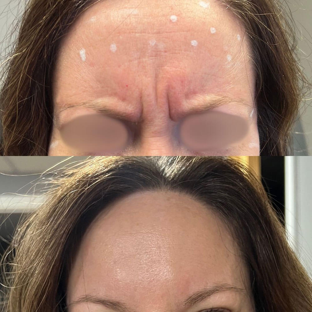 11S-Botox-MOBO-Med-Spa