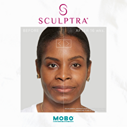 sculptra_before_and_after_2_mediumthumb
