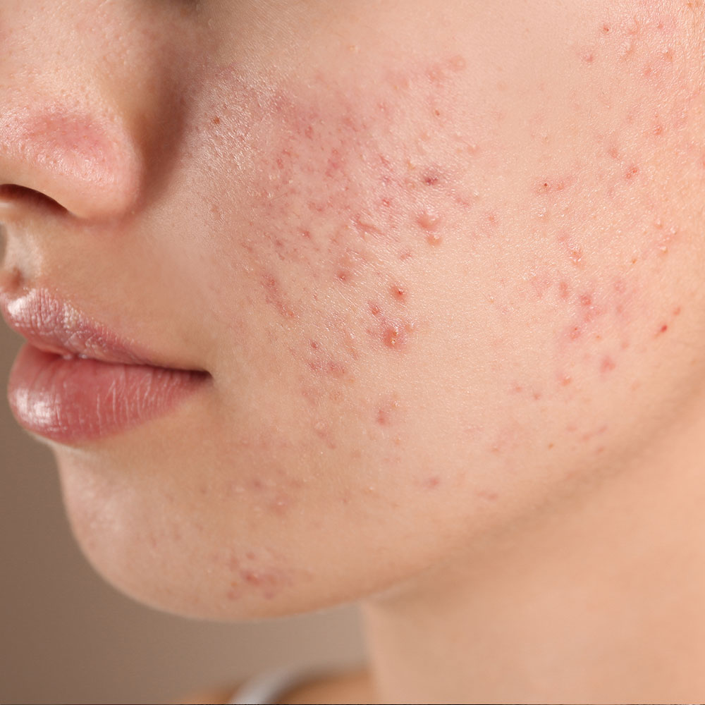 mobo-med-spa-teen-acne-facial
