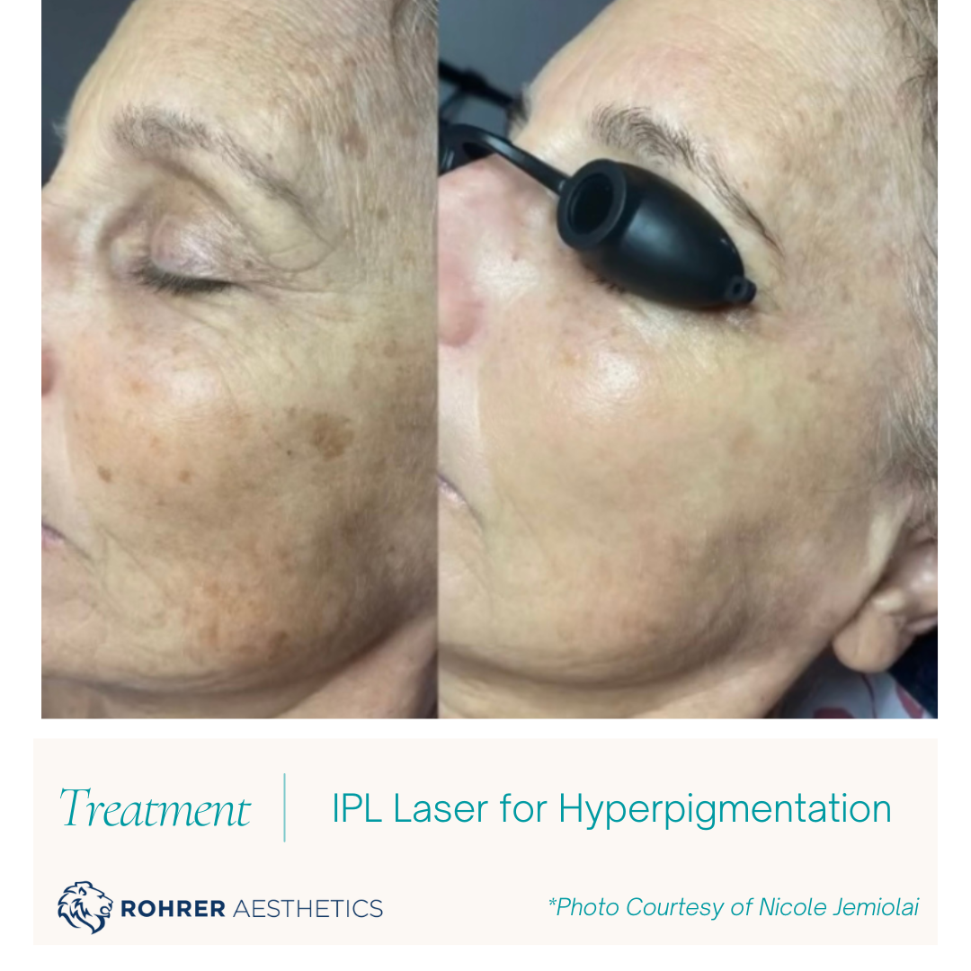 IPL-Laser-2-MOBO-Med-Spa.