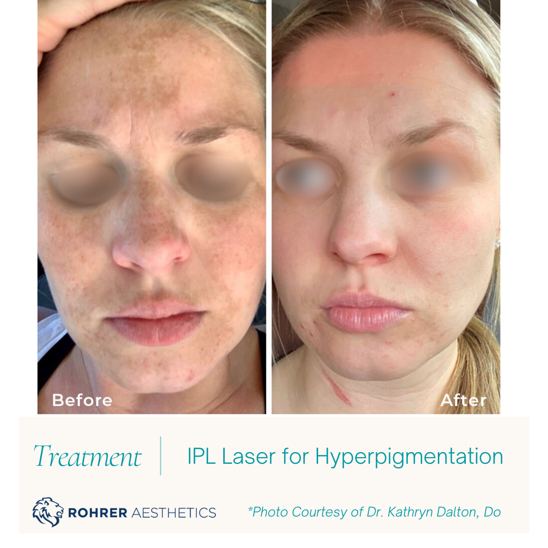 IPL-Laser-MOBO-Med-Spa.