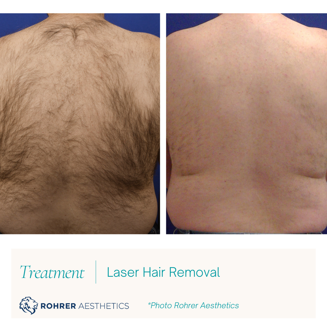 Laser-Hair-Removal-Male-Back-MOBO-Med-Spa.