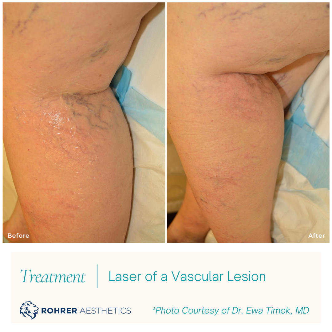 Leg-Vascular-Lesion-Laser-MOBO-Med-Spa.