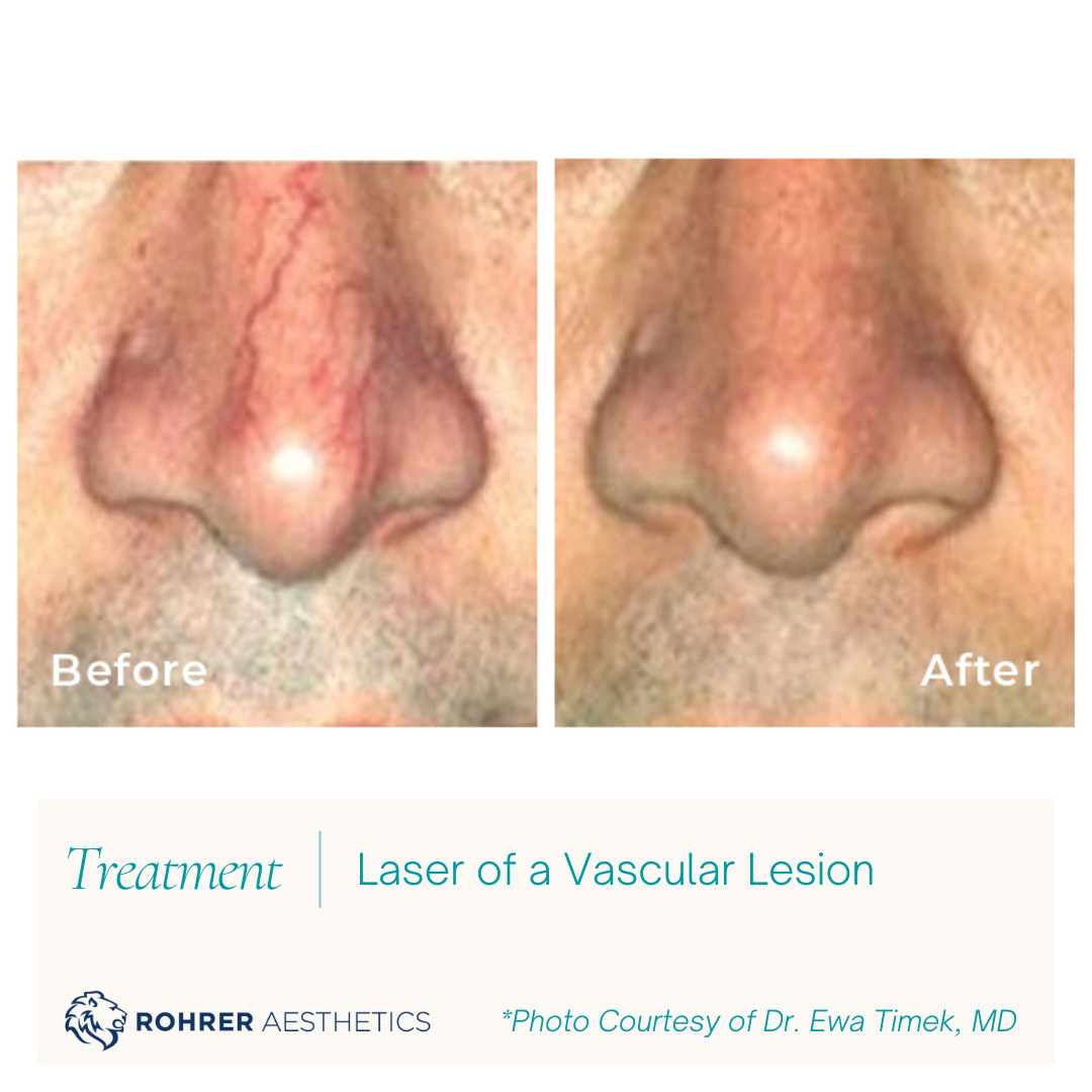 Nose-Vascular-Lesion-Laser-MOBO-Med-Spa