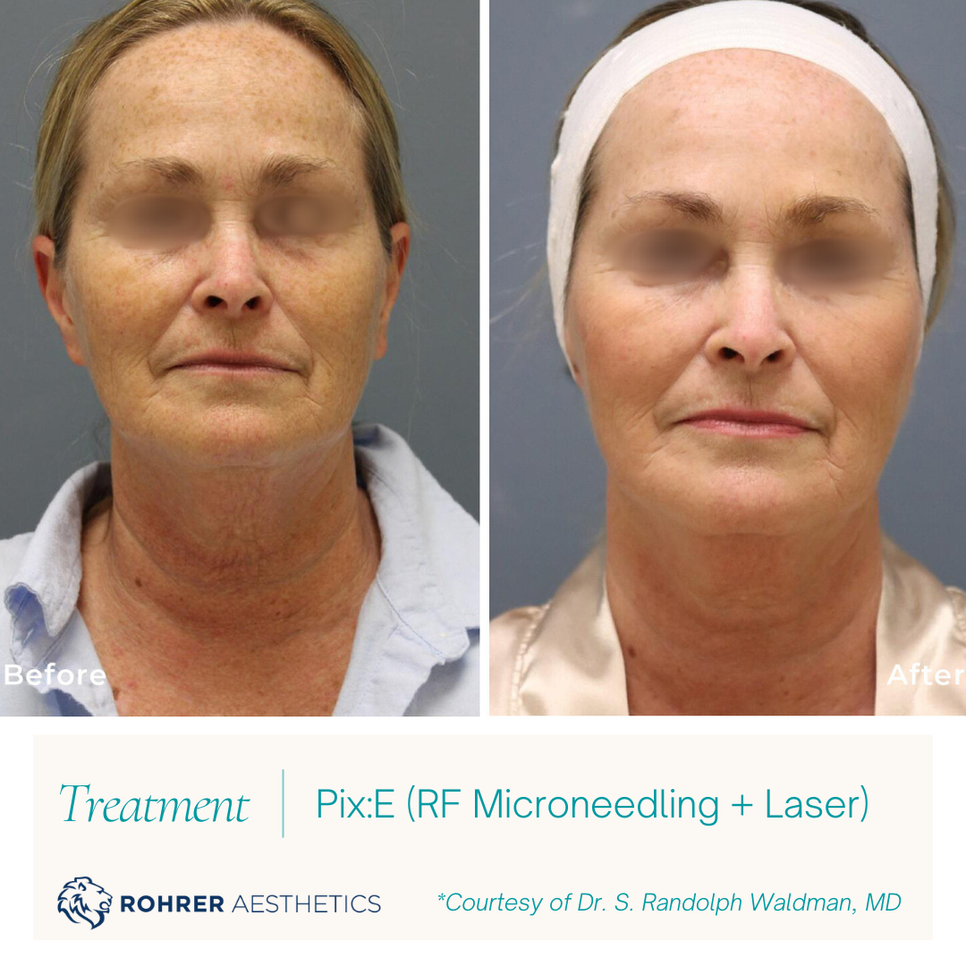 PixE-Laser-RF-Microneedling-MOBO-Med-Spa-2