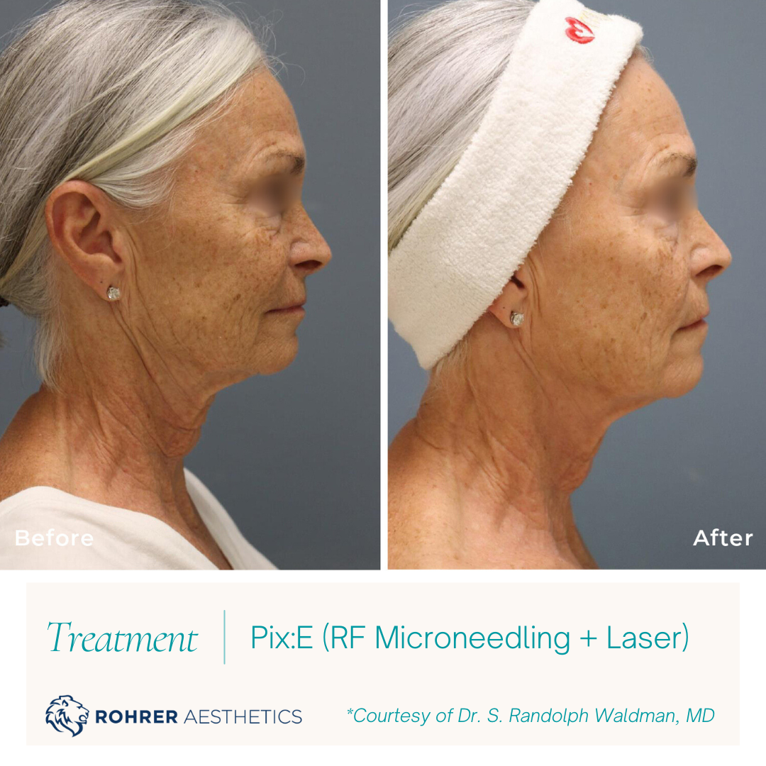 PixE-Laser-RF-Microneedling-MOBO-Med-Spa