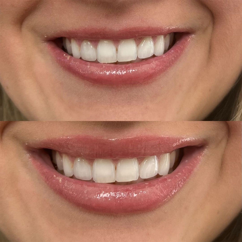 Botox-Lip-Flip-MOBO-Med-Spa-1