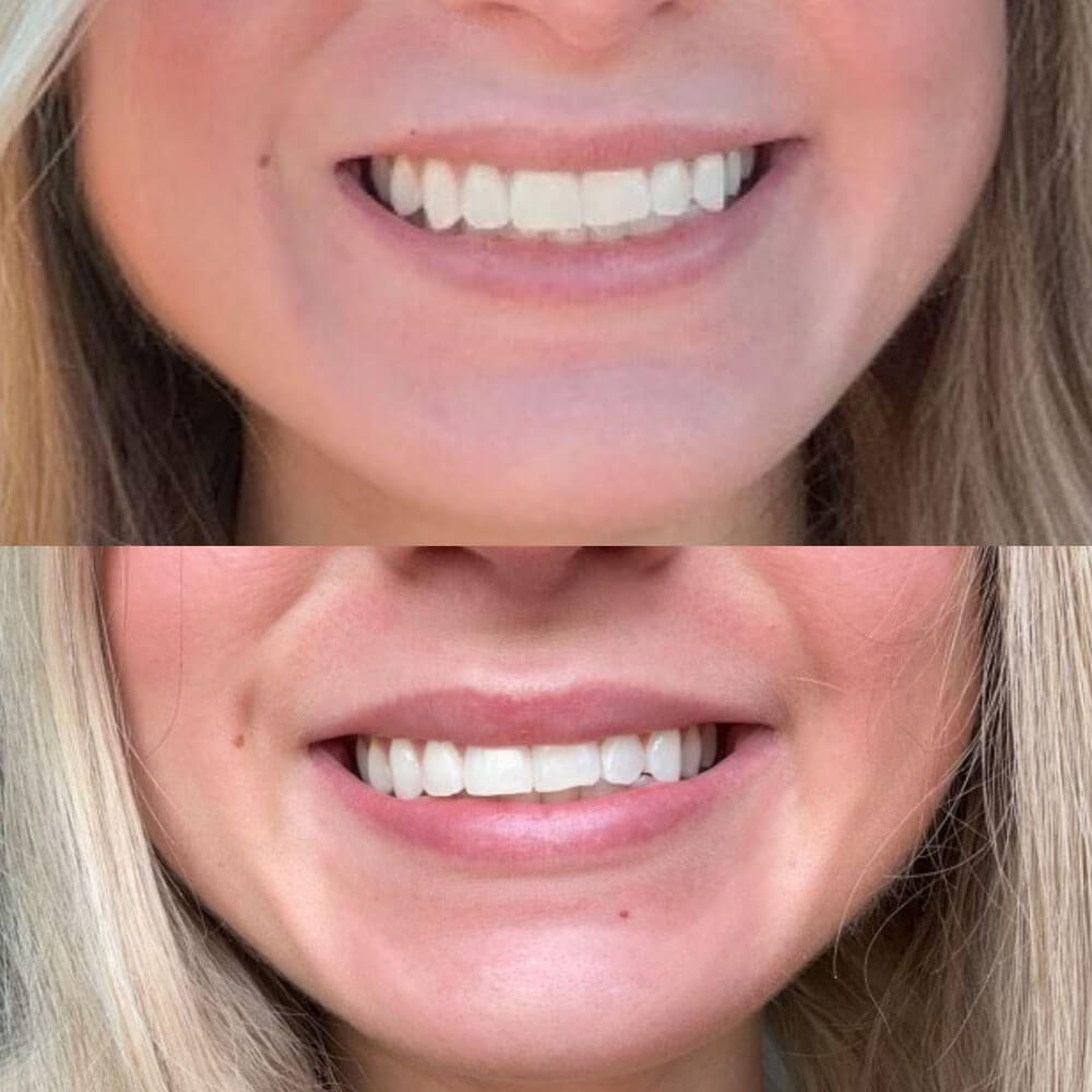 Botox-Lip-Flip-MOBO-Med-Spa-3