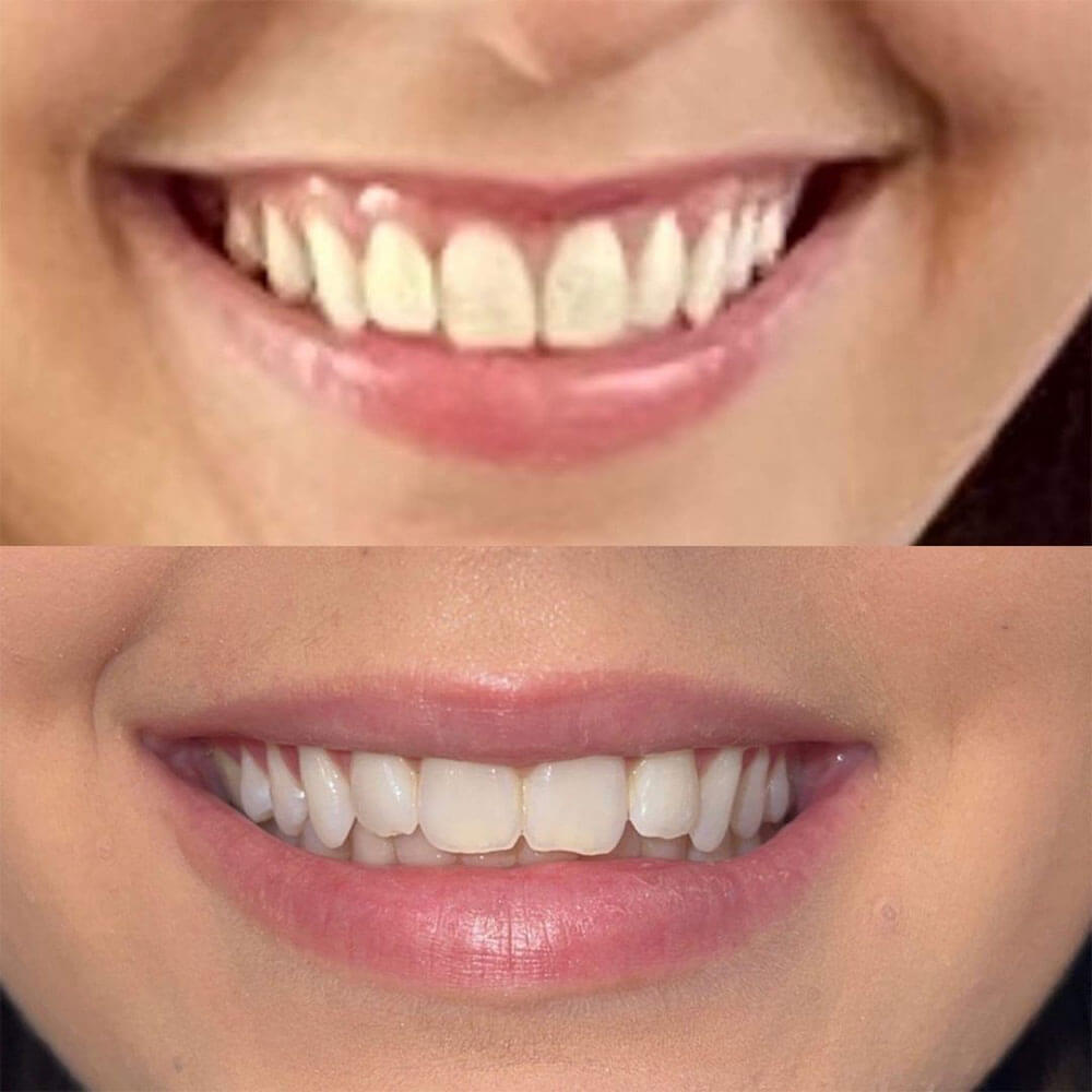 Botox-Lip-Flip-MOBO-Med-Spa2