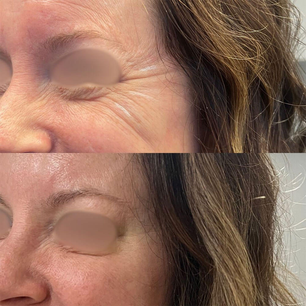 Crows-feet-Botox-MOBO-Med-Spa