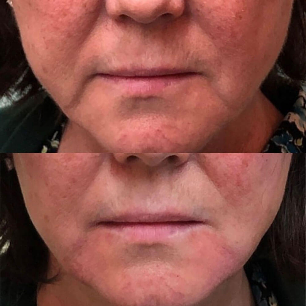 Downward-Smile-Filler-MOBO-Med-Spa