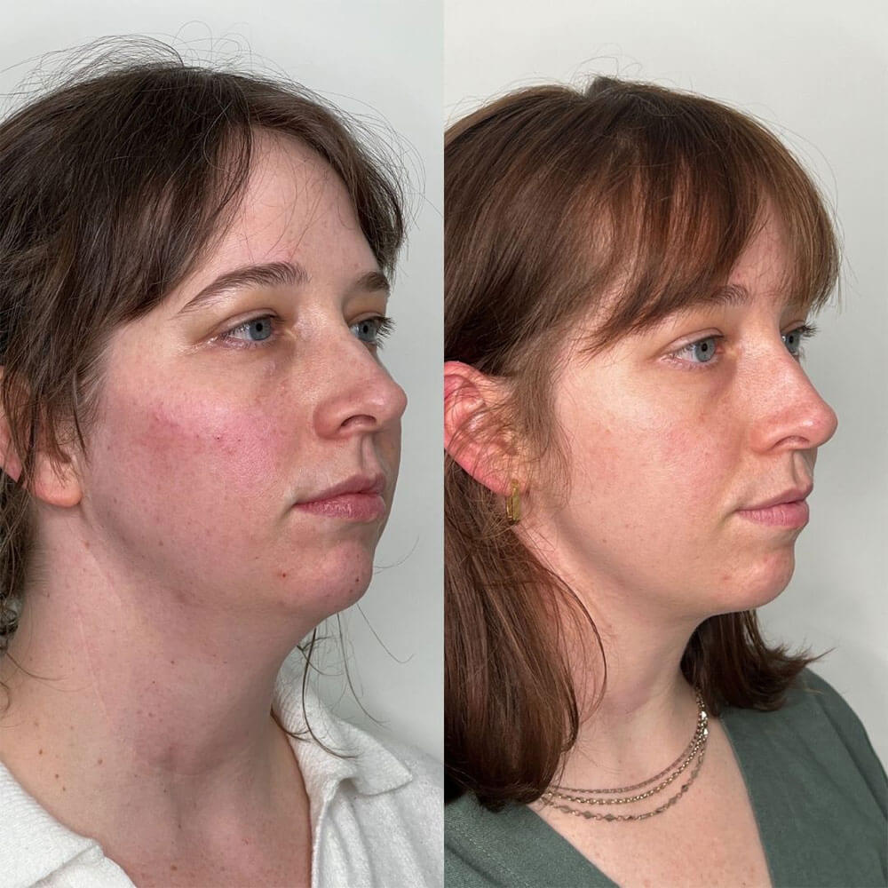 Jawline-Filler-MOBO-Med-Spa3