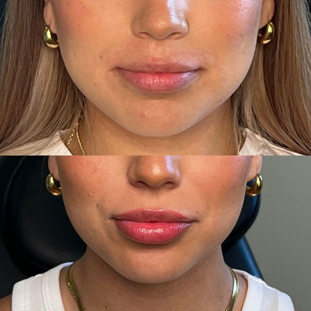 Lip-Filler-MOBO-Med-Spa