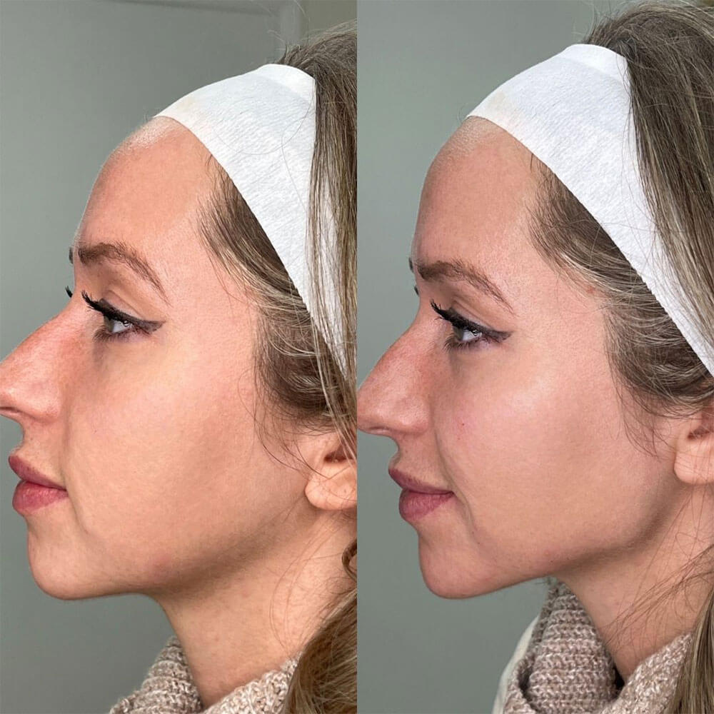 Woman-Jawline-Filler-MOBO-Med-Spa