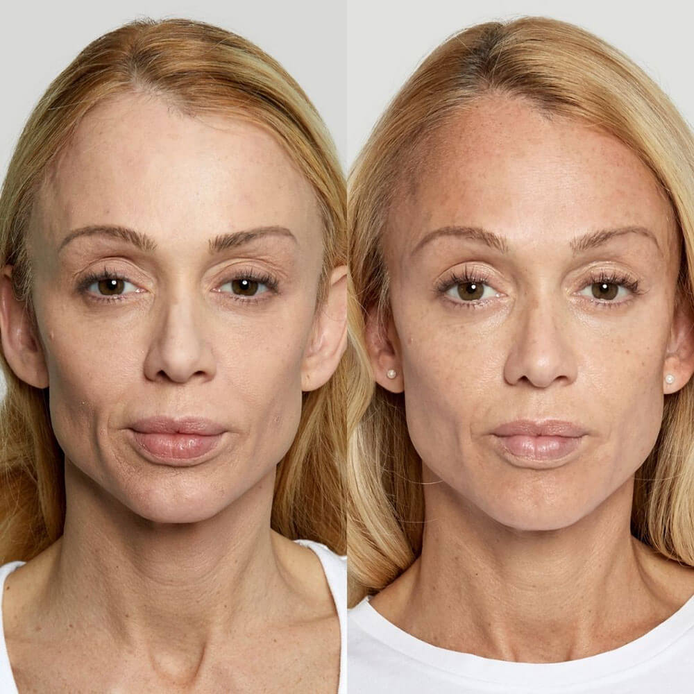 Sculptra-MOBO-Med-Spa