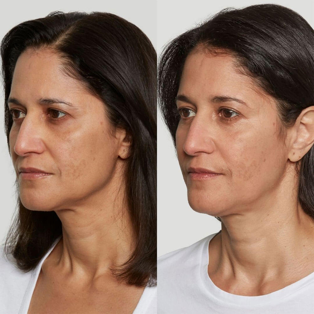 Sculptra-MOBO-Med-Spa2