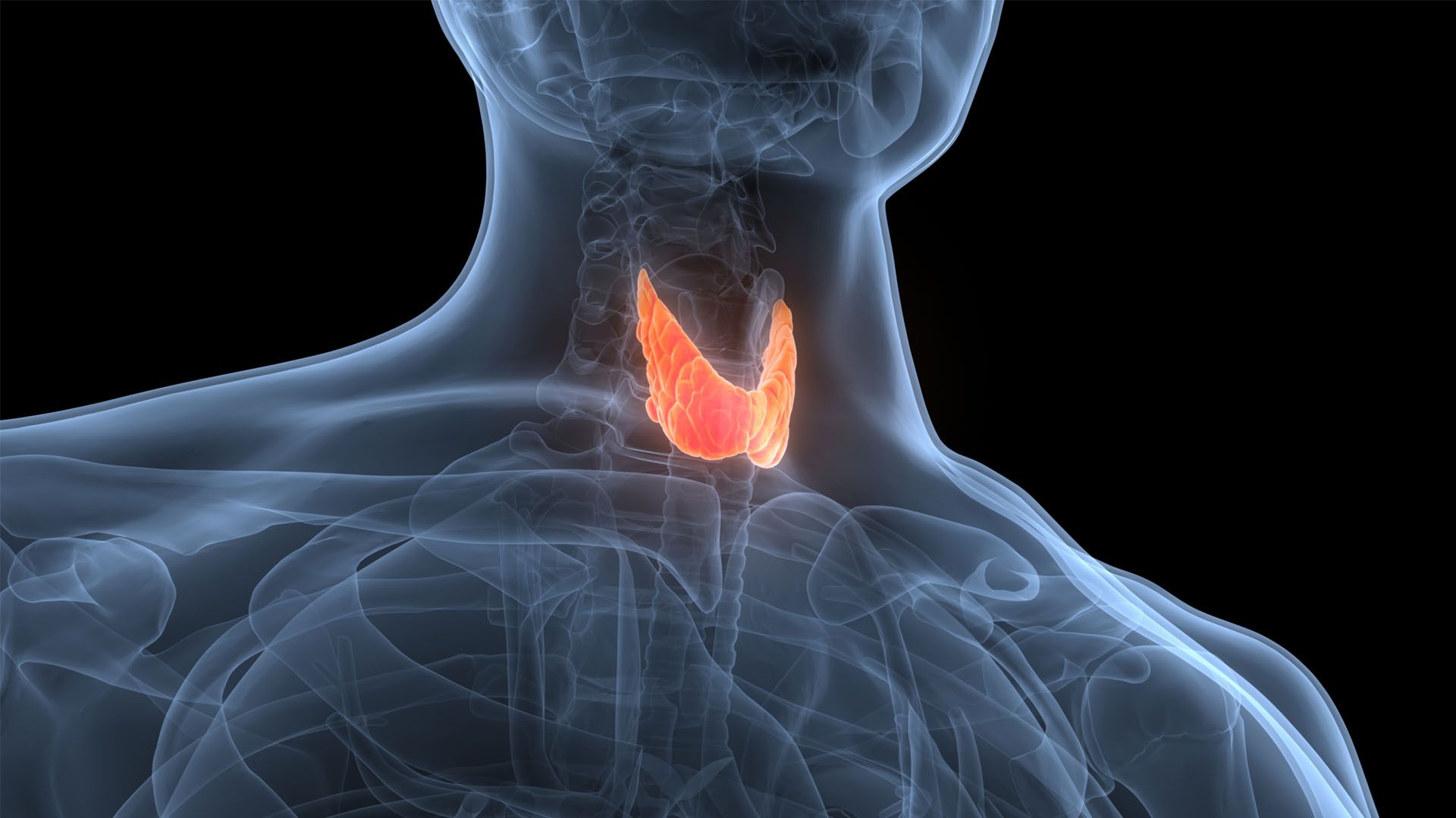 Hypothyroidism side view